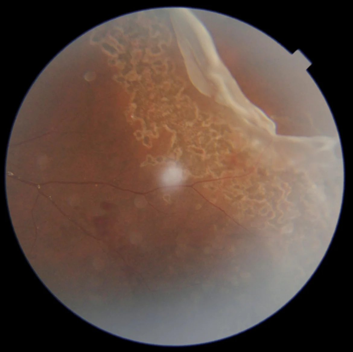 Dubai: Boy’s vision saved after rare eye injury from cricket ball